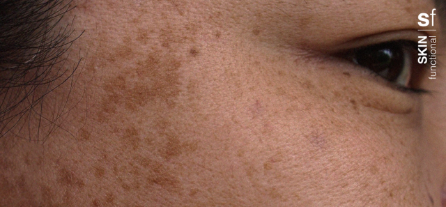 New skin elixir attacks pigmentation head on