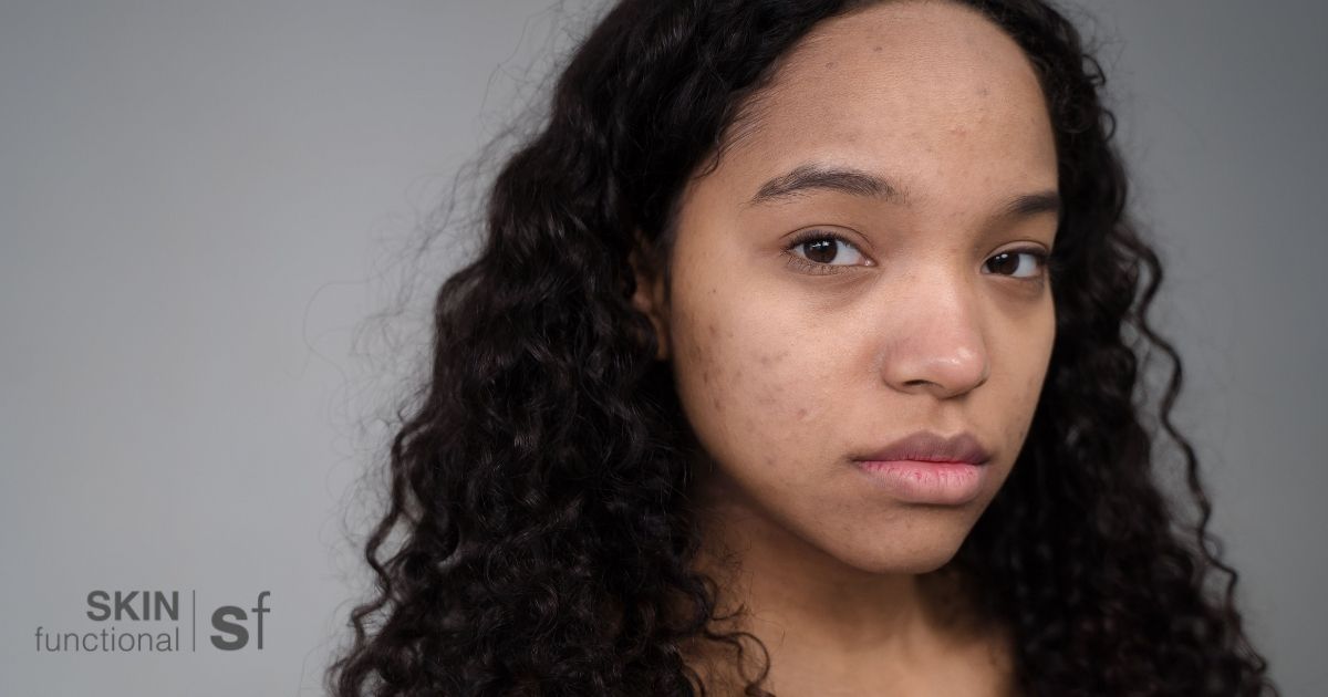 Portrait of a woman with visible post-breakout marks on her skin