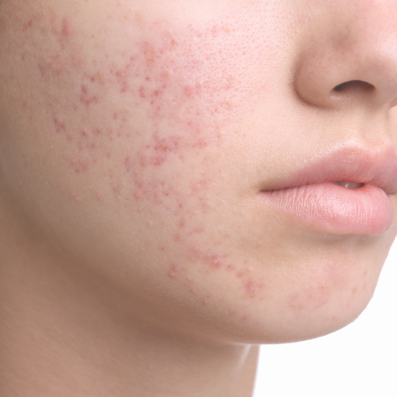 Close-up of skin with acne
