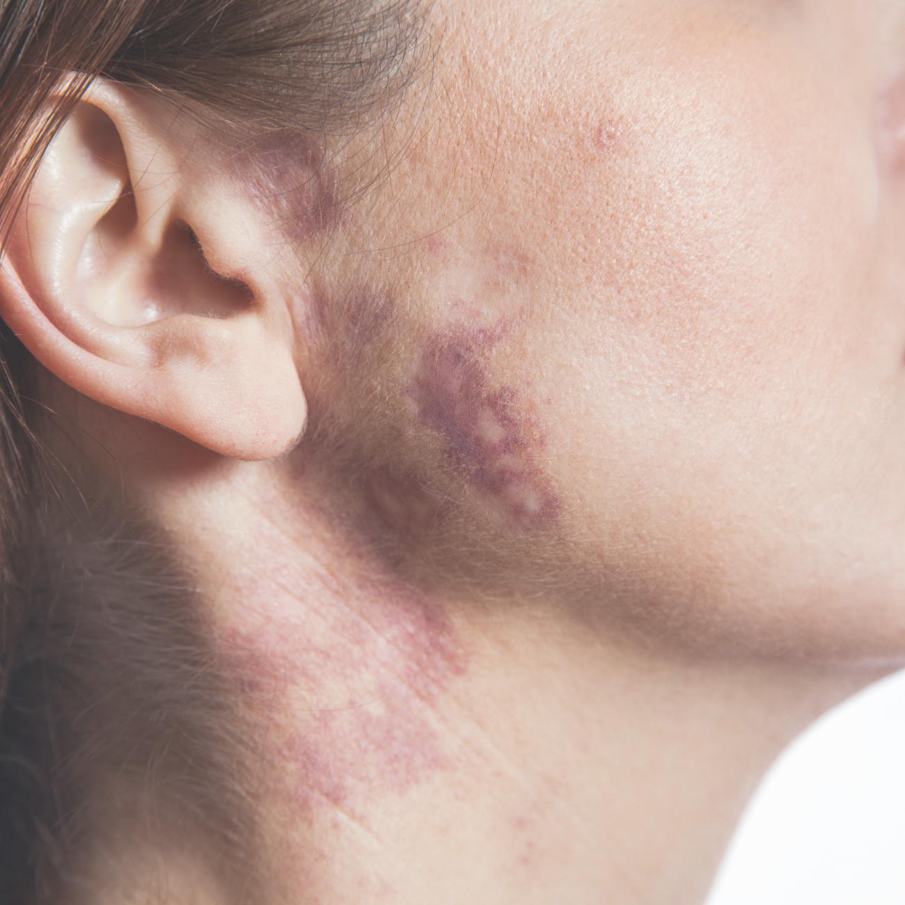 Close-up of the side of a person’s face and neck showing large purple bruising or discoloration 