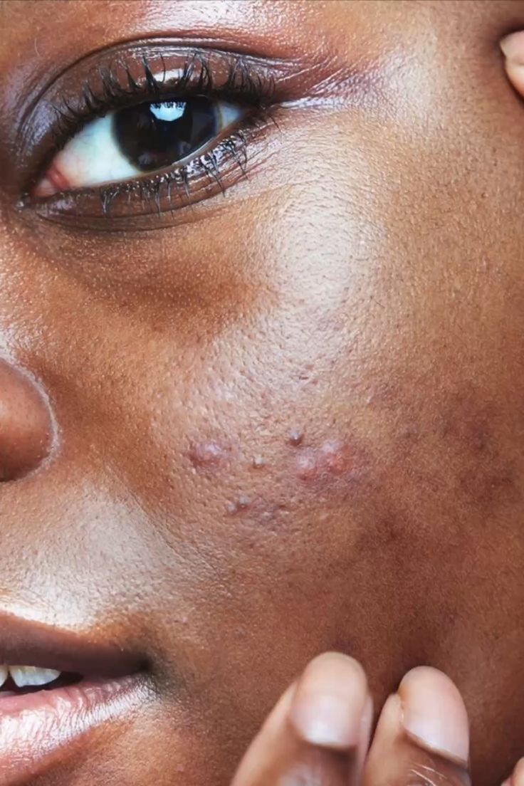 Close-up of a person's face with visible skin blemishes.