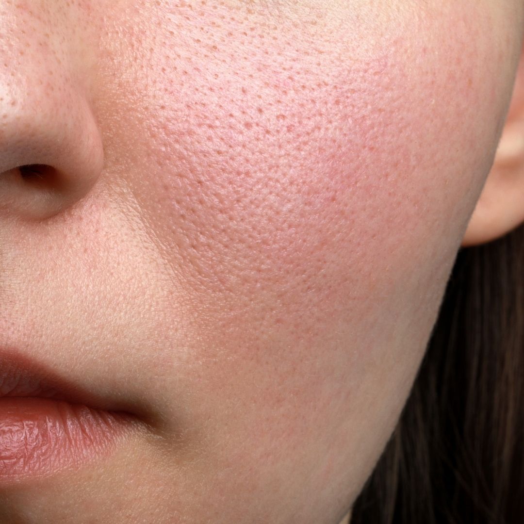 Close-up of a person's face with visible skin texture